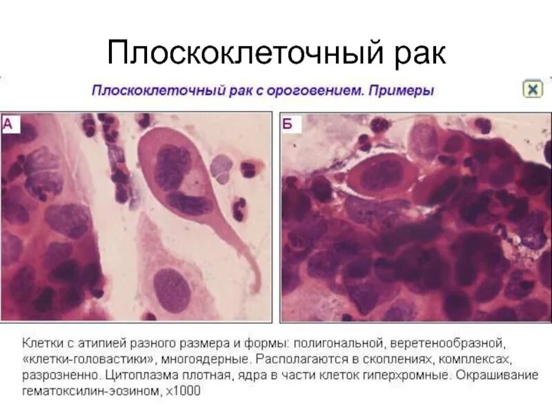 Плоскоклеточный рак кожи: причины возникновения и методы лечения
