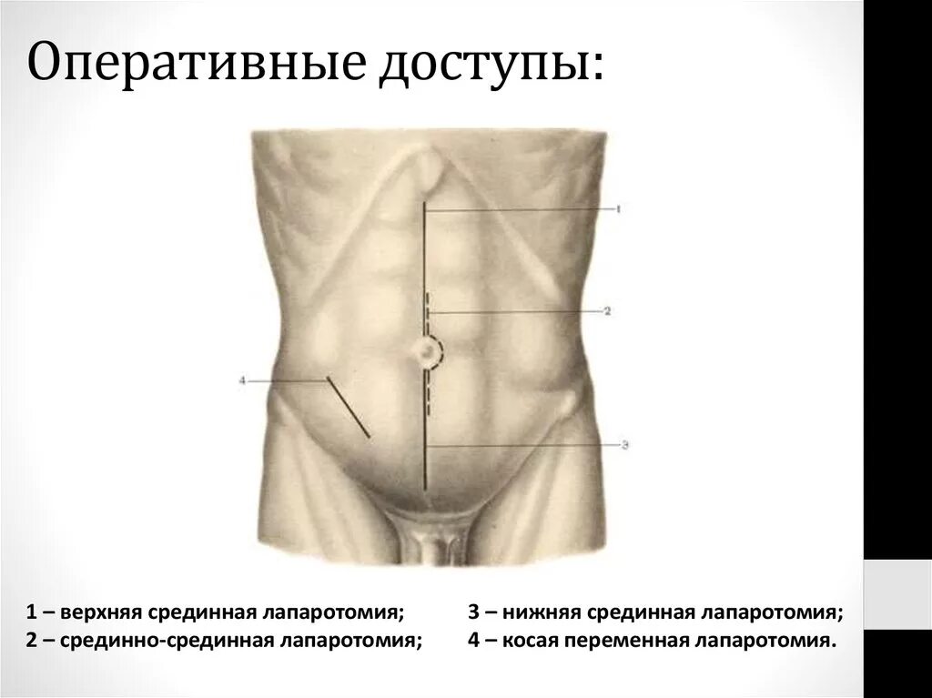 Лапаротомия что это такое простыми словами. Верхняя и нижняя срединная лапаротомия. Линии разрезов продольной лапаротомии. Срединная лапаротомия; параректальная лапаротомия.. Верхняя срединная лапаротомия шов.