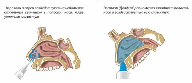 Промывание долфином при гайморите. Промывание долфином при гайморите