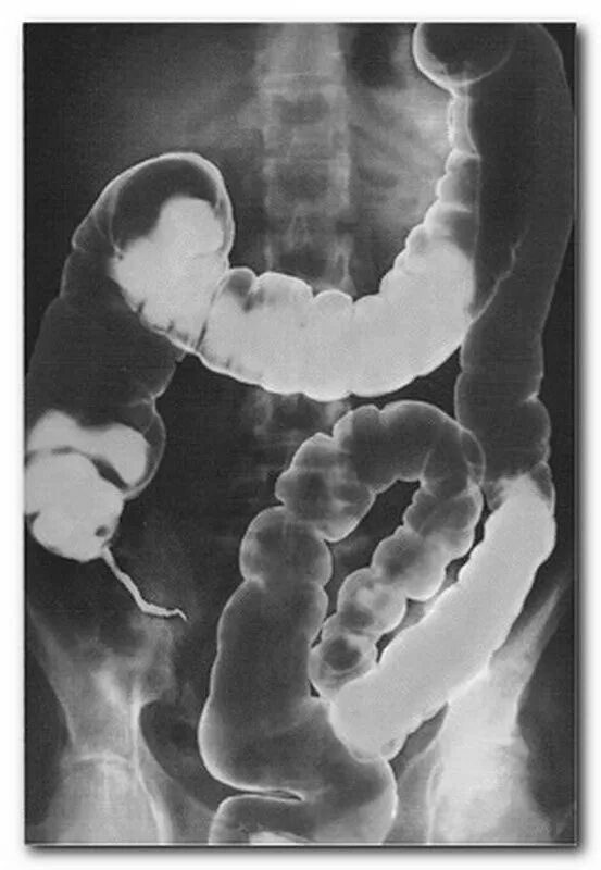 Толстая кишка запор. Ирригография Гиршпрунга. Ирригоскопия дивертикулез. Сигмовидная кишка удлинена рентген.