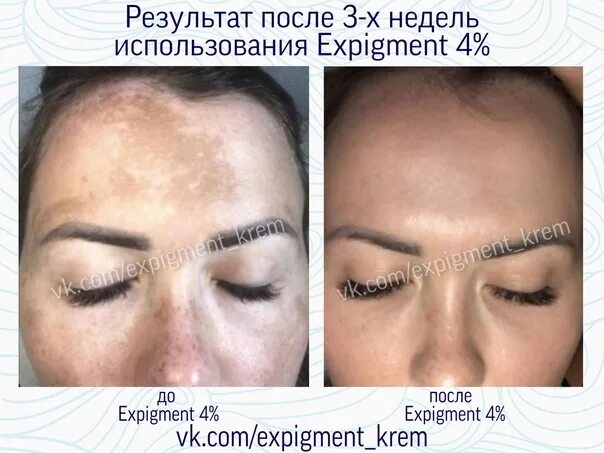 Expigment отзыв до и после Walging Beraadslagen Klacht çil geçiren krem Weglaten Meisje levenslang