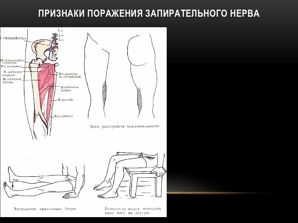 Поражение двигательного нерва. Синдром поражения запирательного нерва. Кожная ветвь запирательного нерва. Симптом поражения бедренного запирательного седалищного нерва. Запирательный нерв иннервация.