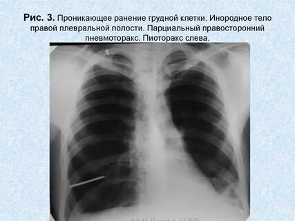 Проникающие ранения плевральной полости