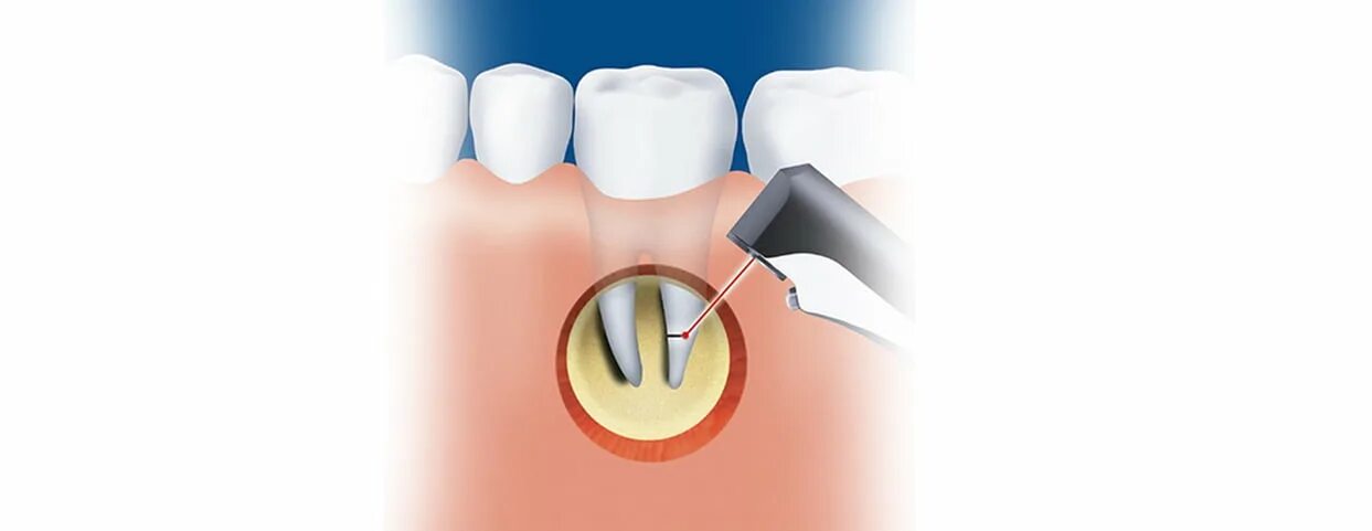 Зубосохраняющие операции (резекция верхушки корня. Резекция верхушки корня зуба. Операция резекции верхушки корня зуба.