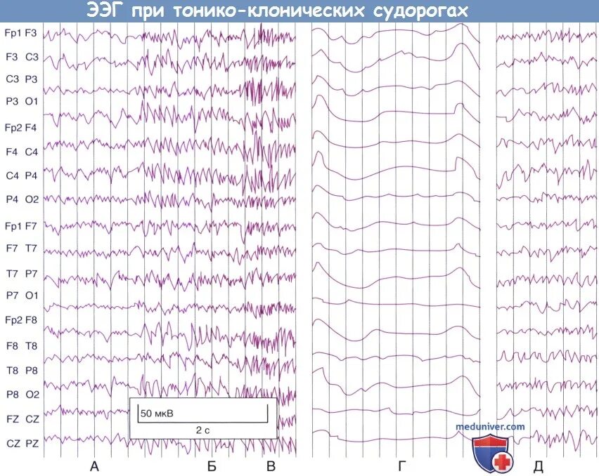 Пароксизмальная ээг. ЭЭГ при эпилептическом припадке. Региональная эпилептиформная активность ЭЭГ. Электроэнцефалография, норма, ЭЭГ, видеомониторинг ЭЭГ при эпилепсии\. ЭЭГ показатели больного эпилепсией.
