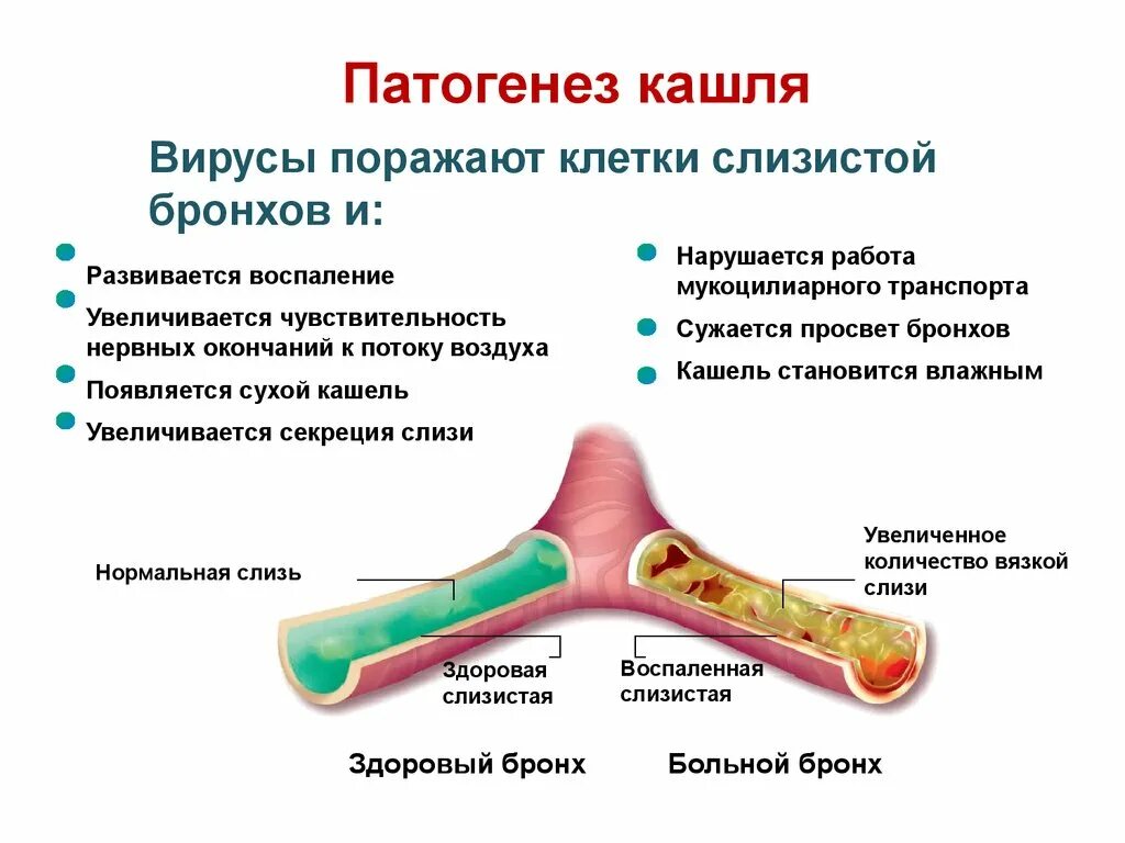 Бронхит развитие. Механизм развития кашля. Механизм развития кашля при пневмонии. Патогенез кашля при бронхите. Механизм возникновения острого бронхита.