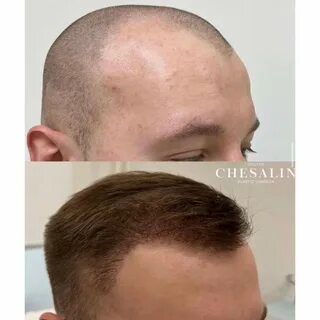 Сколько после пересадки волос