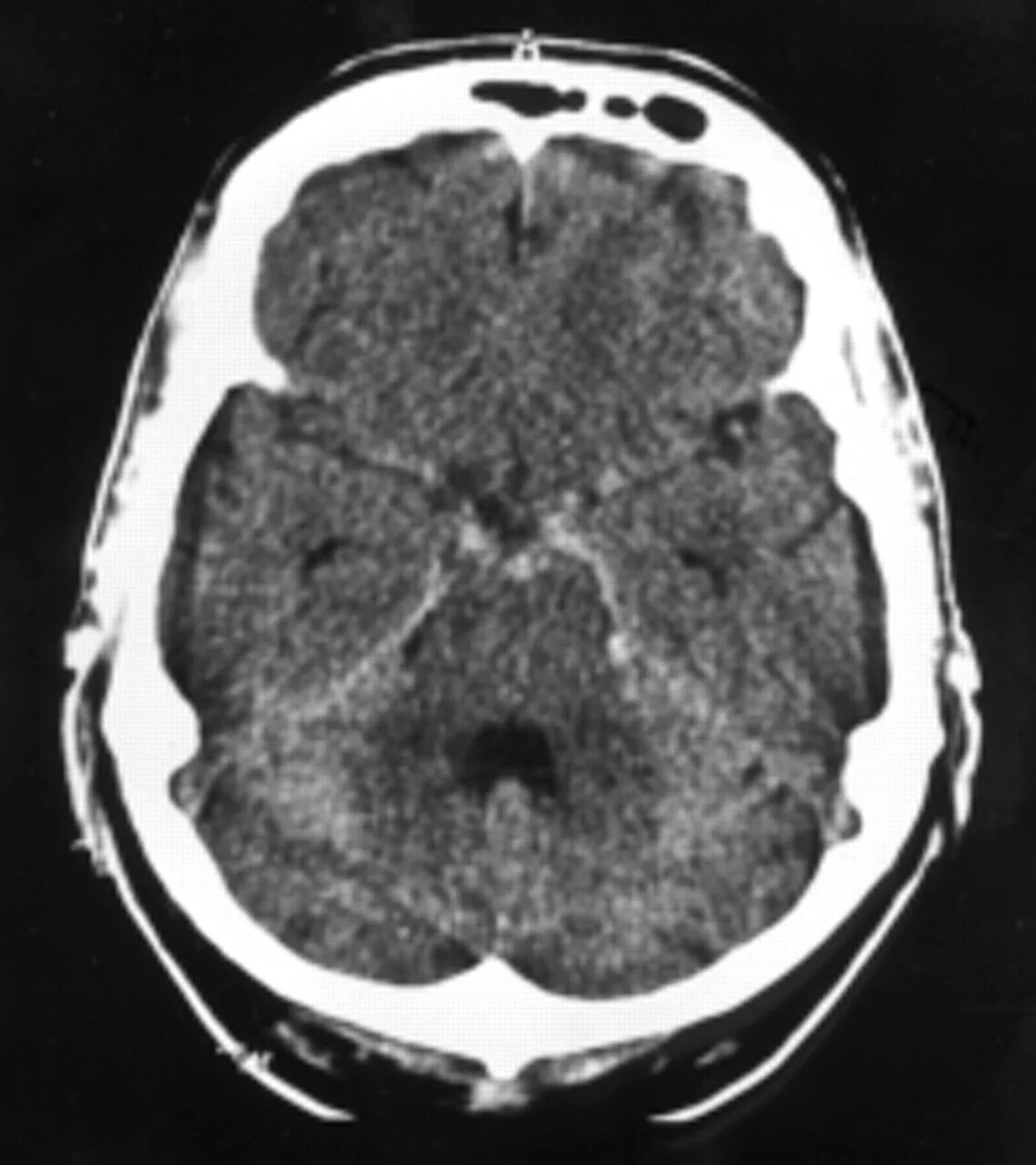 Субарахноидальное кровоизлияние мрт. Субарахноидальное кровоизлияние кт. Травматическое субарахноидальное кровоизлияние кт. Субарахноидальный инсульт кт.