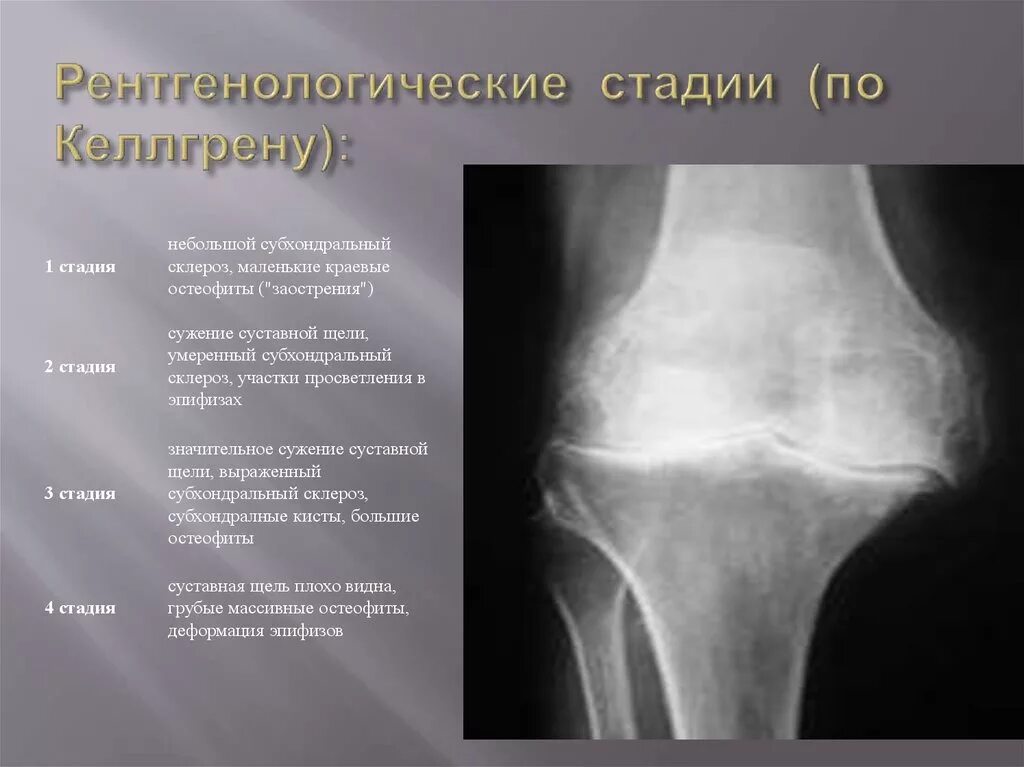 Kellgren тазобедренный сустав. Артроз пателлофеморального сочленения коленного сустава рентген. Остеоартрит тазобедренного сустава рентген. Деформирующий остеоартроз тазобедренного сустава по Kellgren. Сужение коленных суставов