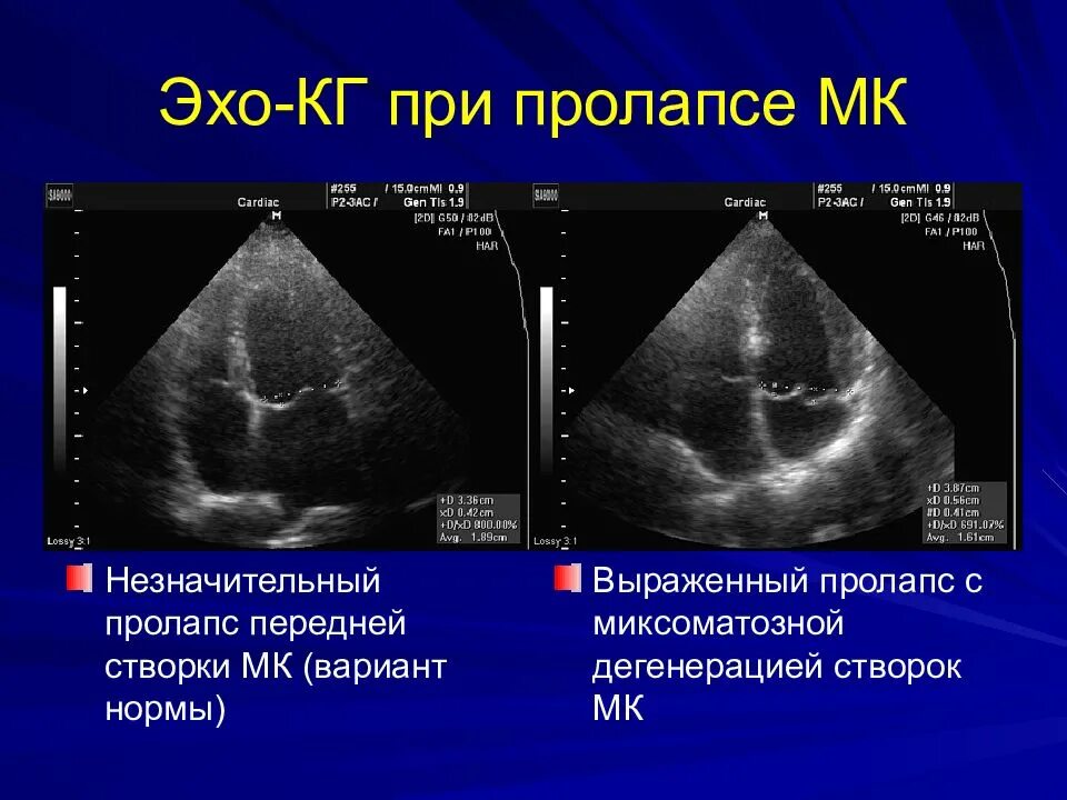 Миксоматозная дегенерация. Пролапс митрального клапана на УЗИ сердца. Пролапс митрального клапана 1 степени на УЗИ. Эхо кг пролапс митрального клапана. ЭХОКГ при пролапсе митрального клапана.