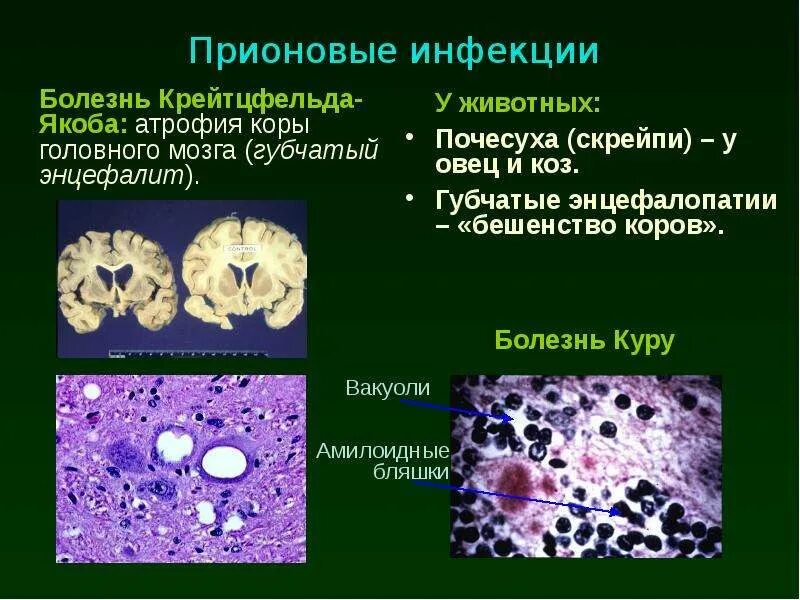 Прионные болезни болезнь Крейтцфельдта Якоба. Болезнь Крейтцфельдта-Якоба гистология. Болезнь Куру Крейтцфельдта Якоба. Болезнь Крейтцфельдта-Якоба мозг. Больные куру