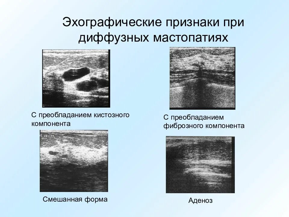 Диффузно инфильтративная. Аденоза молочной железы УЗИ. Фиброзно кистозная мастопатия молочной железы УЗИ. Мастопатия с преобладанием фиброзного компонента УЗИ. Диффузная фиброзно-кистозная мастопатия на УЗИ.