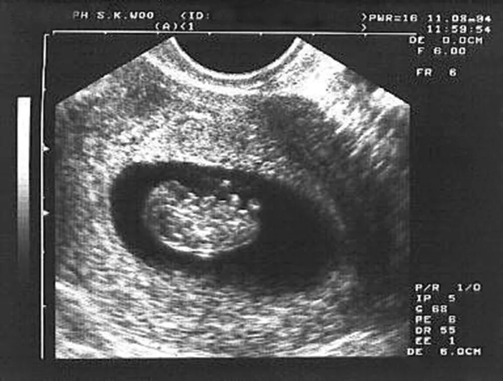 УЗИ на 8 неделе беременности акушерской. Эмбрион на 8 неделе беременности УЗИ. УЗИ 8.5 недель беременности. Фото УЗИ плода на 8 акушерской неделе беременности.