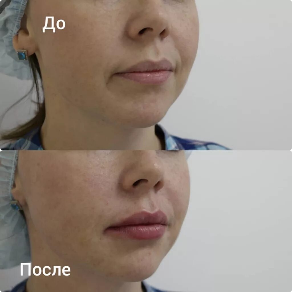 Филлеры в щеки до и после: найдено 85 картинок