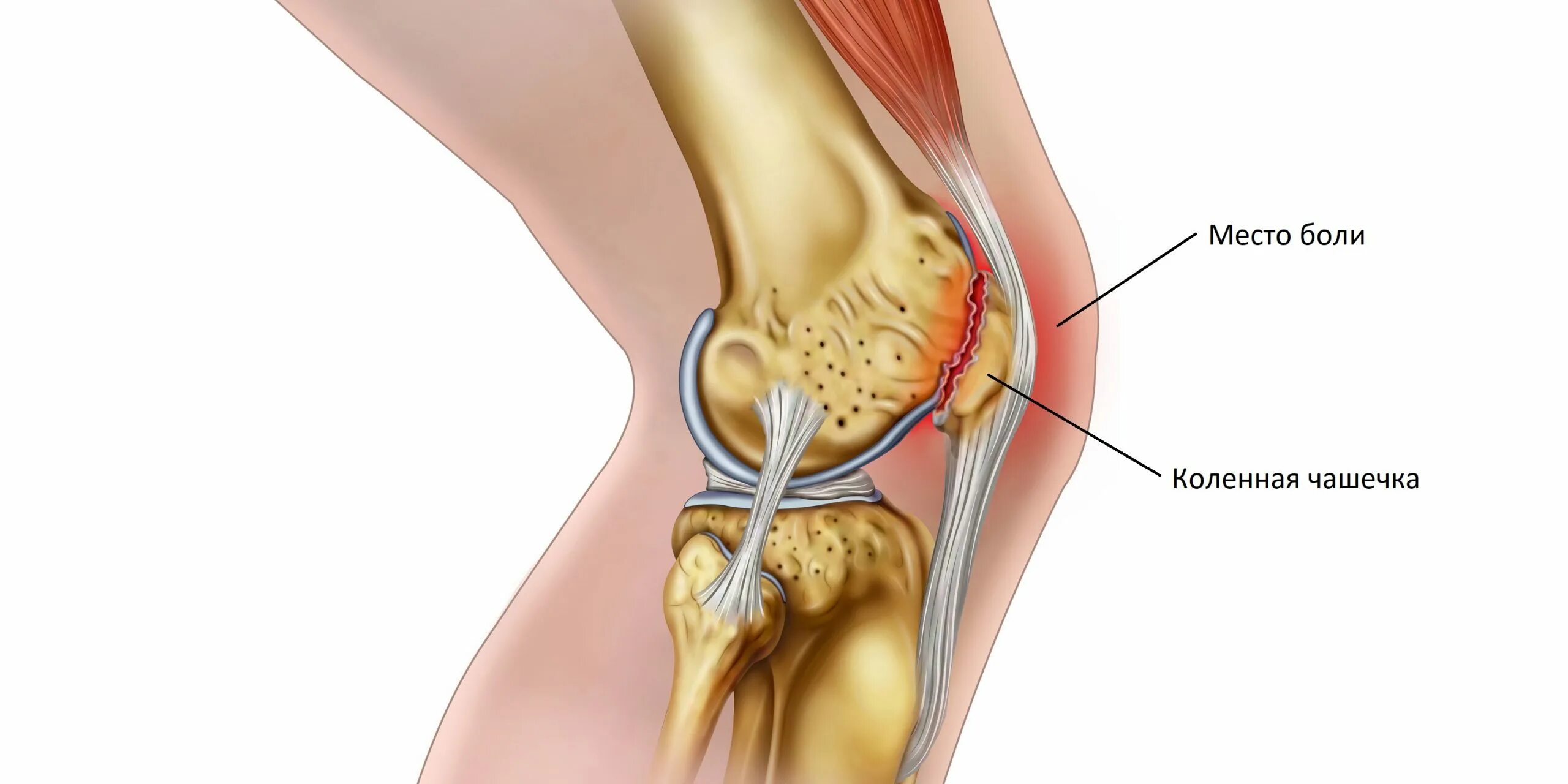 Заболело колено причины. Колено пателлофеморальный болевой синдром. Синдром Гоффа коленного сустава. Пателлофеморальная хондромаляция. Пателло-феморального сустава.