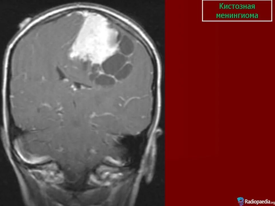 Менингиома сильвиевой щели. Менингиома сильвиевой борозды. Кистозно атрофические изменения головного