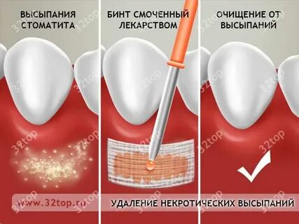 Антибиотики после имплантации