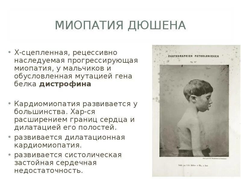 Мышечная дистрофия у детей симптомы. Симптомы поражения при миопатии дюшенна:. мышечная дистрофия дюшенна причины. миопатия клинические проявления. миопатия дюшенна причины болезни.