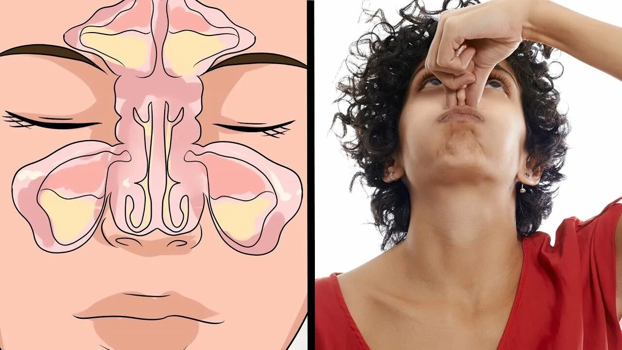 Как пробить нос от заложенности срочно. От заложенности носа. Устранение заложенности носа. Упражнения от заложенности носа. Гимнастика для заложенности носа.