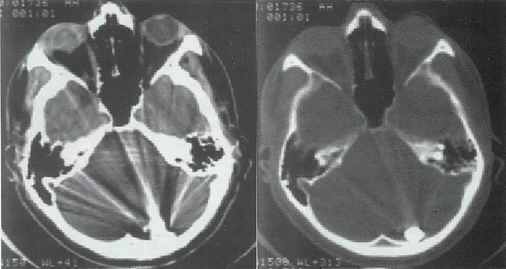 Артефакты на компьютерной томографии. Итеративная реконструкция кт-изображений. Артефакты на кт головного мозга. Артефакты кт типы. Виды артефактов на кт.