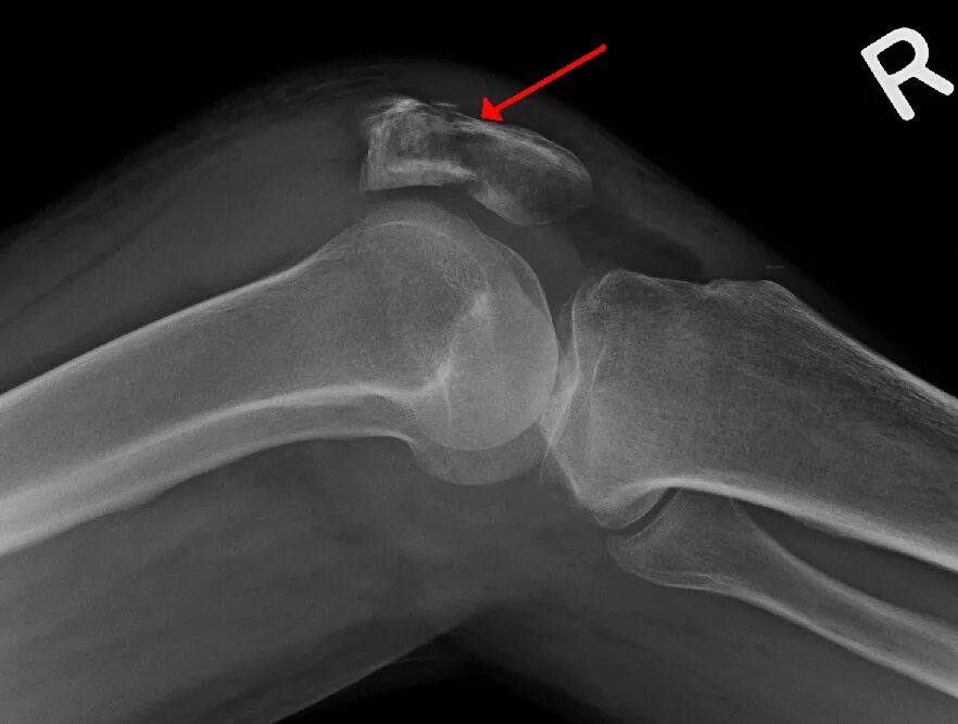 Перелом надколенника рентген. Перелом коленного сустава рентген. Оскольчатый перелом надколенника.