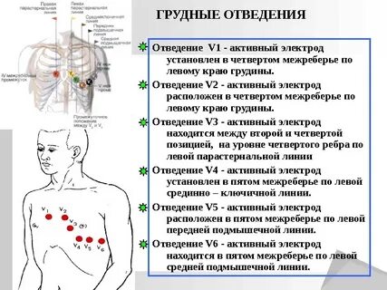 Наложение электродов при экг схема по цветам