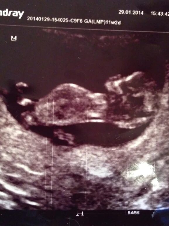 Узи мальчика и девочки на 12 неделе. Половой бугорок на узи. Половой бугорок на узи. Узи 1 скрининг мальчик девочка. Половой бугорок в 10 недель.