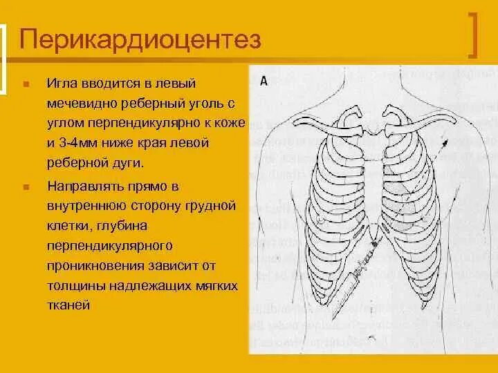 Печень ниже реберной дуги. Проекция мечевидного отростка грудины. Мечевидный отросток грудной клетки человека. Под мечевидным отростком грудины. Отросток в грудной клетке.