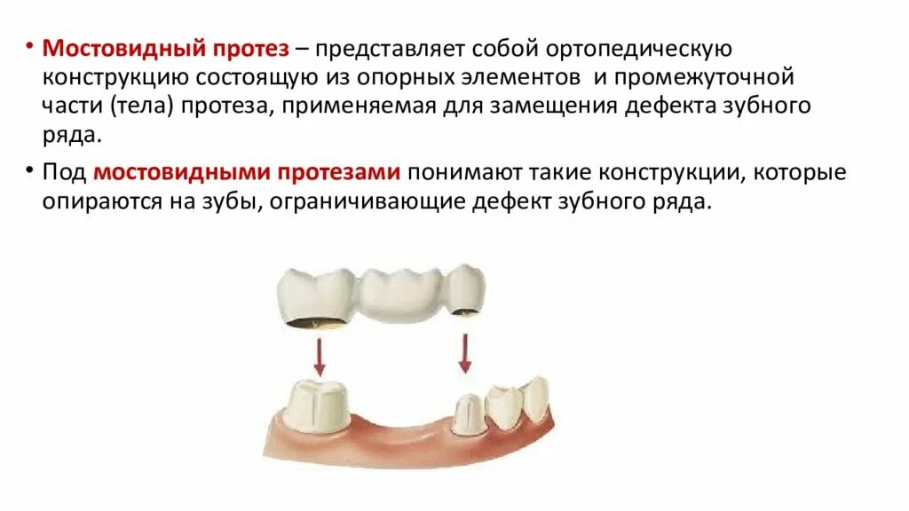 Противопоказания к изготовлению коронки. Составные элементы мостовидных протезов. Промежуточная часть цельнолитого мостовидного протеза. Формы промывной части мостовидного протеза. Опорный элементы баянного мастовидного протеза.