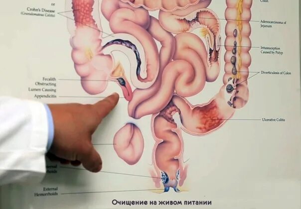 Аппендикс эволюция. Строение человека аппендикс. Расположение органов человека аппендикс. Расположение внутренних органов человека аппендикс. Анатомия человека аппендицит.