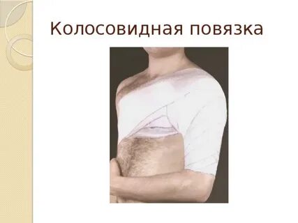 Колосовидная повязка