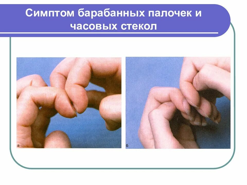 Признак палочки. Симптом барабанных палочек. симптом барабанных палочек и часовых стекол. симптом ьарабанных аалосек. барабанные палочки и часовые стекла.