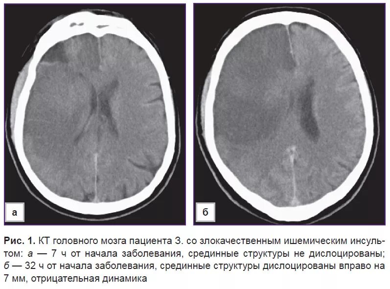 Ишемический инсульт на кт головного мозга. Кт мрт ишемического и геморрагического инсульта. Стадии ишемического инсульта на кт. Ишемический инсульт кт картина. Геморрагический инсульт кт мрт.