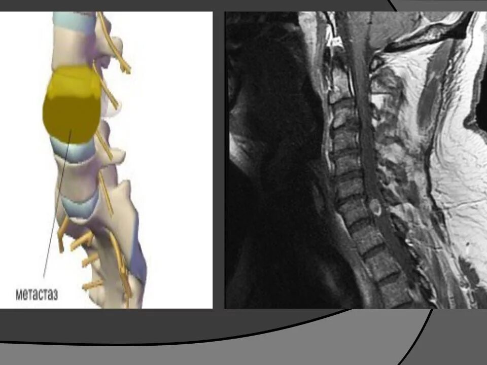 Как долго живут с метастазы в позвоночнике