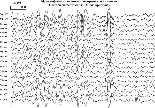 Диффузная эпилептиформная активность. Эпилептические паттерны на ЭЭГ. Генерализованная эпилептиформная активность на ЭЭГ У ребенка. Как выглядят эпи волна на ЭЭГ. ЭЭГ эпилепсия пик-волна.