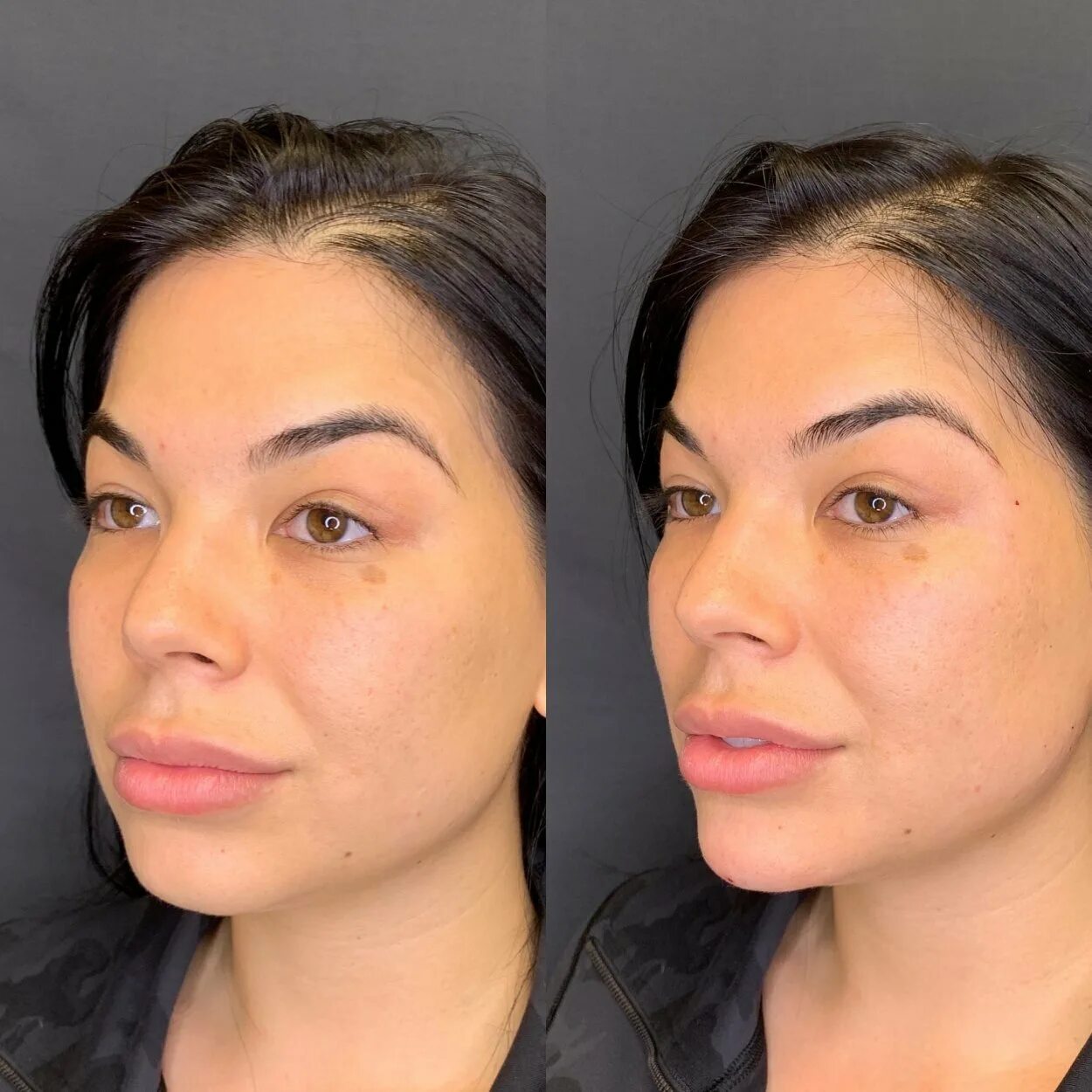 Пластика филлером профиль джоли. Подбородок. Контурная пластика подбородка. Красивый женский нос. Коррекция скул и подбородка филлерами.