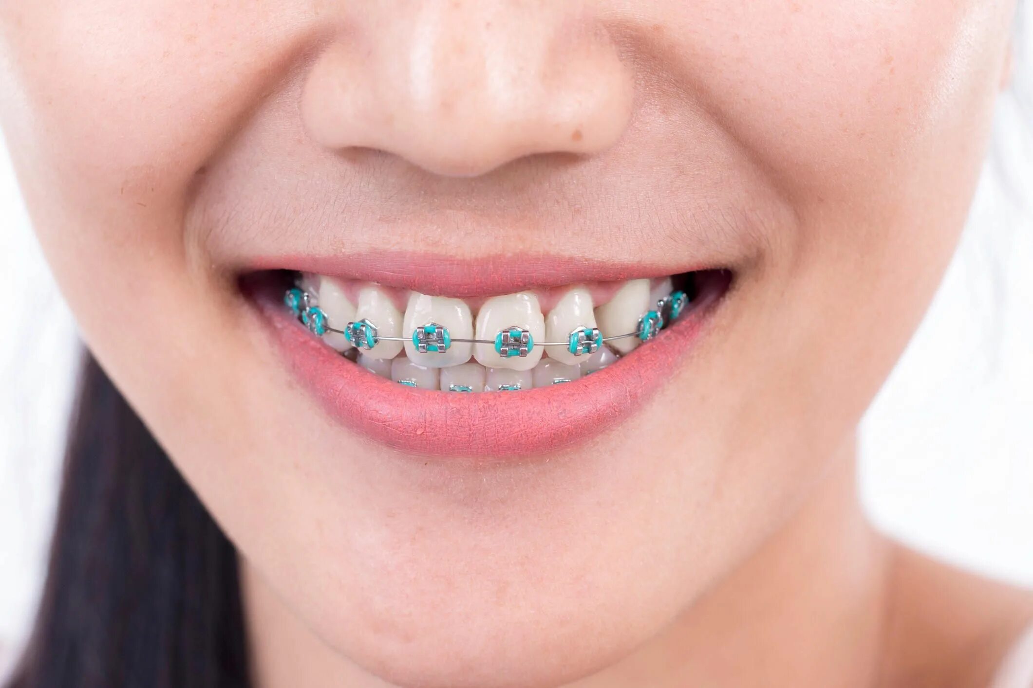 Brackets photo