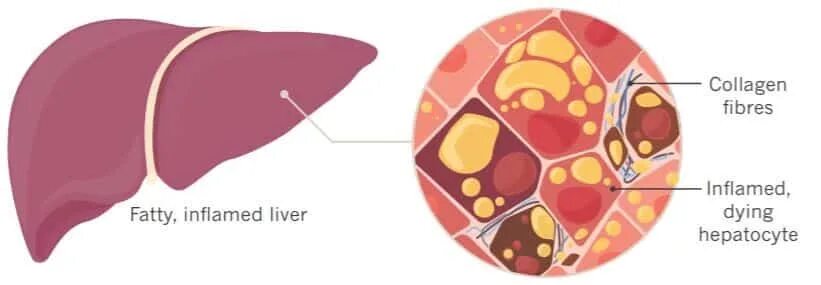 Жировое перерождение печени, цирроз печени. Жировой гепатоз (стеатоз) печени. Жировое перерождение клетки. Жировое перерождение печени (жировой гепатоз). Жировое перерождение клетки.
