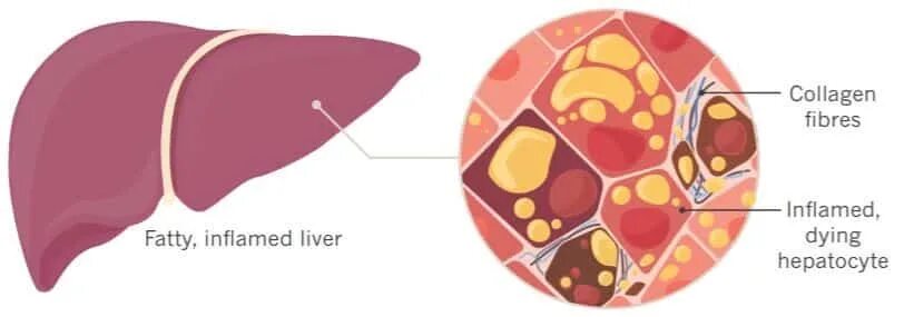 Печень в организме в жире. Неалкогольный жировой гепатоз печени. Неалкогольная жировая дистрофия печени. Неалкогольный цирроз печени.