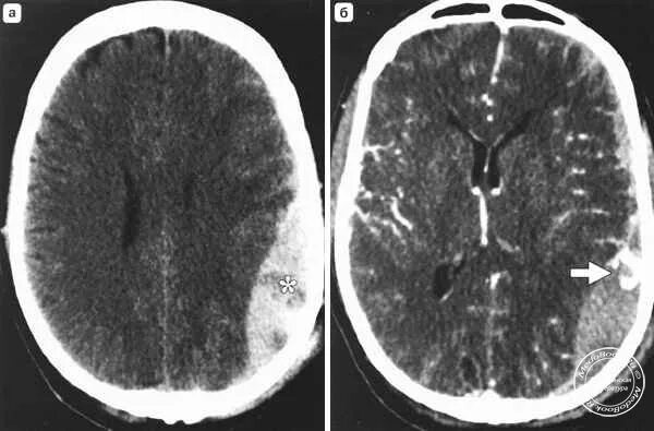 гематома мозга кт. гематома мозга кт. кт картина субдуральной гематомы. субапоневротическая гематома кт. кт картина субдуральной гематомы.
