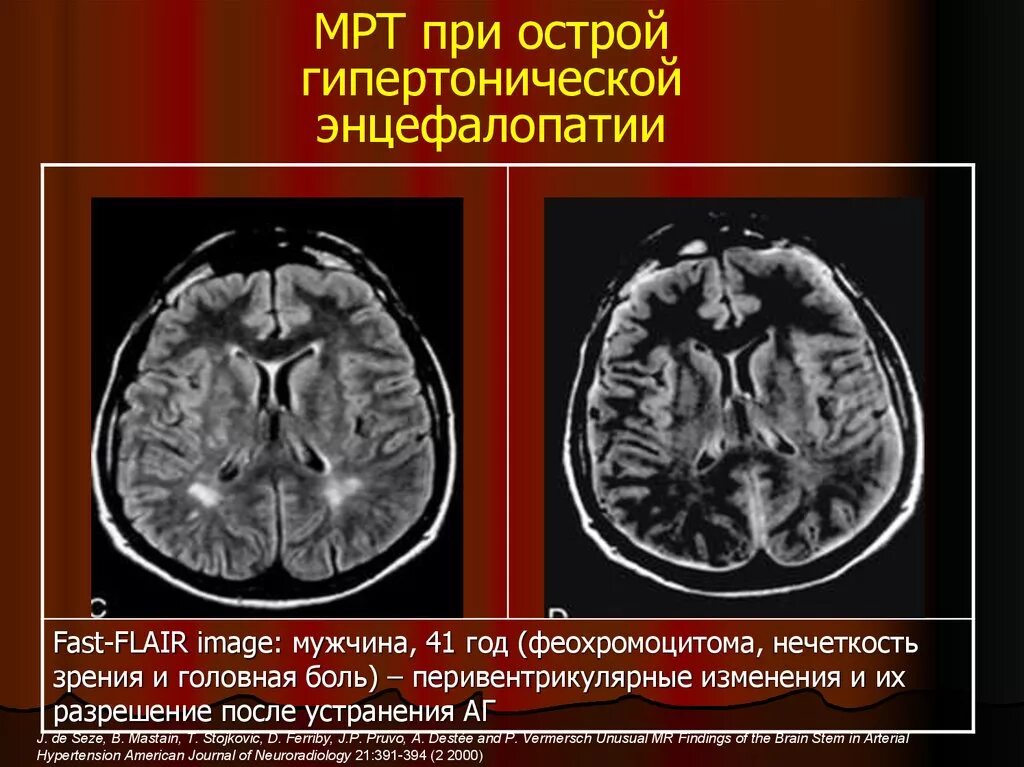 Полное поражение головного мозга. Гипертензивная энцефалопатия мрт. Острая гипертоническая энцефалопатия мрт. Острая почечная гипертензионная энцефалопатия. Гипертоническая мультиинфарктная энцефалопатия мрт.