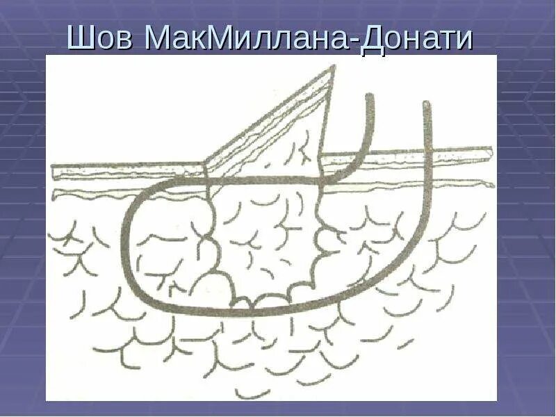 Шов мак-миллана –донати. Шов мак-миллана –донати. Шов мак-миллана –донати. Вертикальный матрацный шов донати. Шов по альговеру техника.