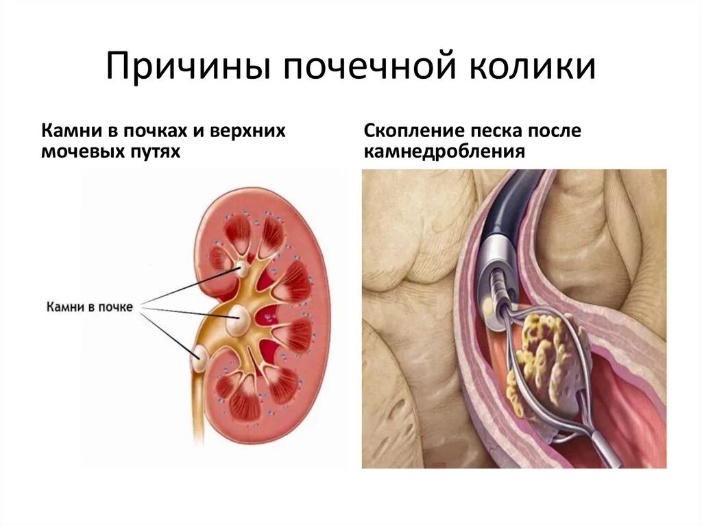 Причины развития почечной колики. Почечная колика причины. Почки при почечной колике. Почечная колика симптомы первая