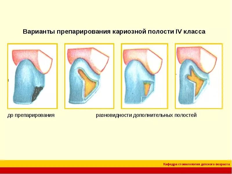 Ошибки при препарировании кариозных полостей. Варианты препарирования полостей 4 класса по блэку. отпрепарированная полость 4 класса по блеку. препарирование полостей 4 класса по блэку. кариозная полость 4 класса по блэку.