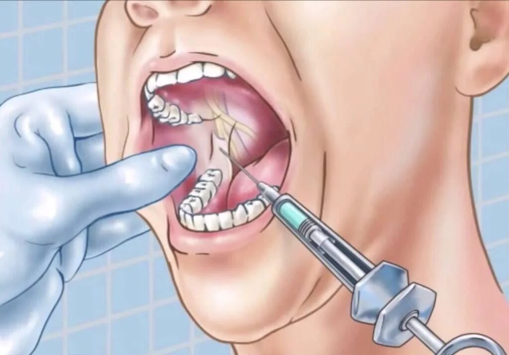 обезболивающие в стоматологии при удалении зуба