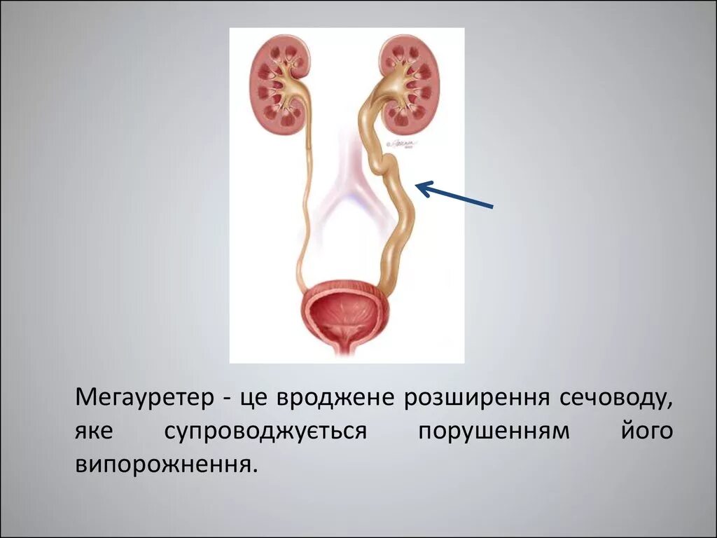 Мегауретер у детей что это. Нерефлюксирующий мегауретер. мегауретер это расширение мочеточника. нерефлюксирующий мегауретер у детей. мегауретер у детей клинические рекомендации.