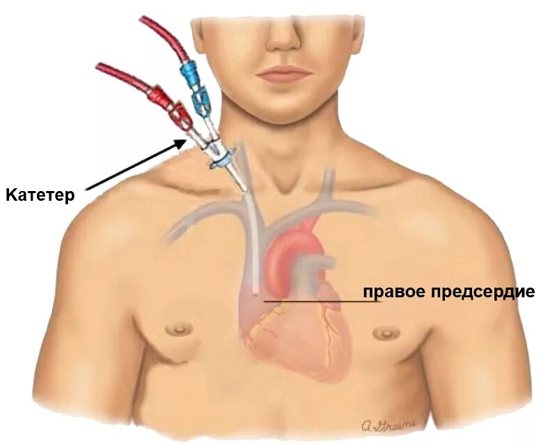 Самая самая шунт. Подключичный катетер для гемодиализа. Подключичный венозный катетер. Центральный венозный катетер для диализа. ЦВК Центральный венозный катетер.