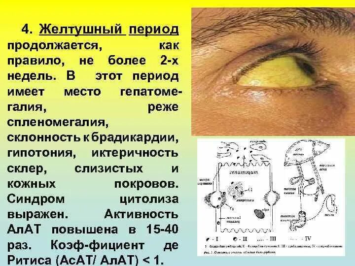 Желтушный вирусный гепатит. Желтушный период гепатита а. Желтушный период вирусных гепатитов. Вирусный гепатит желтушный период