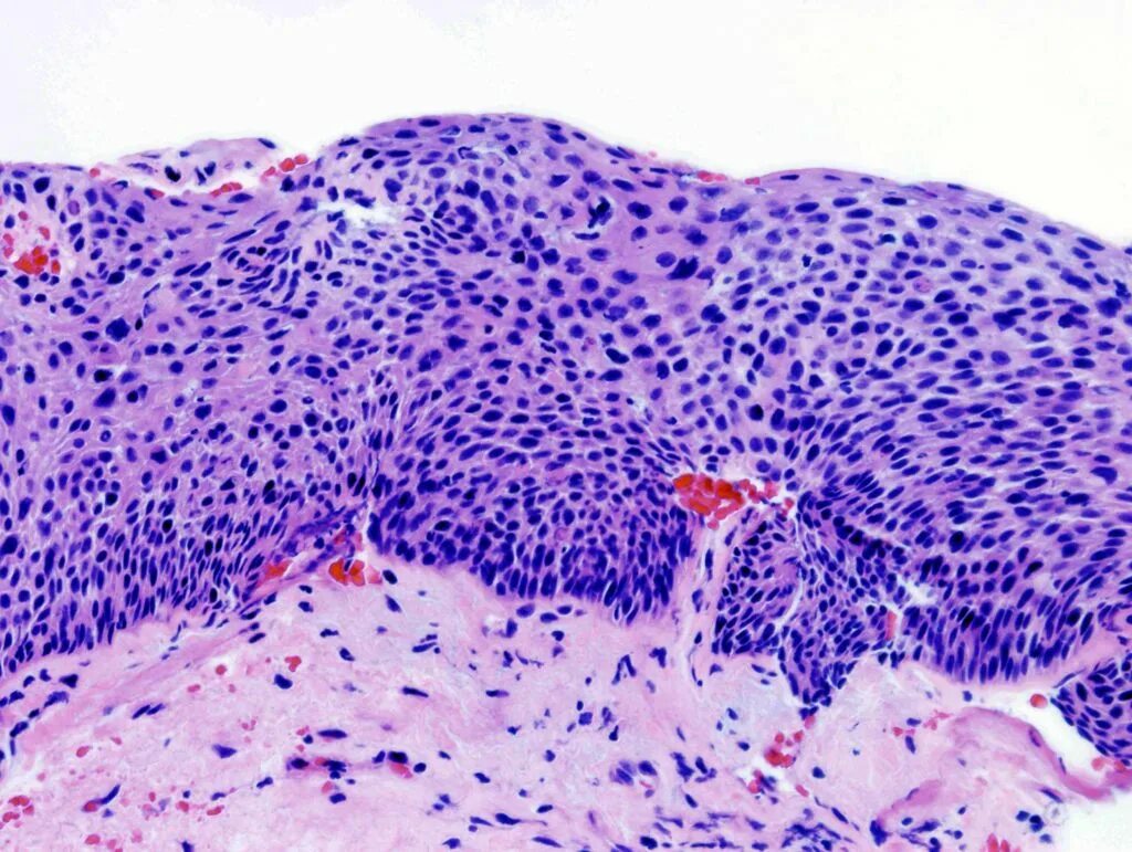 Squamous Cell carcinoma гистология. Плоскоклеточная карцинома шейки матки гистология. Карцинома ин ситу шейки матки гистология. Рак in situ шейки