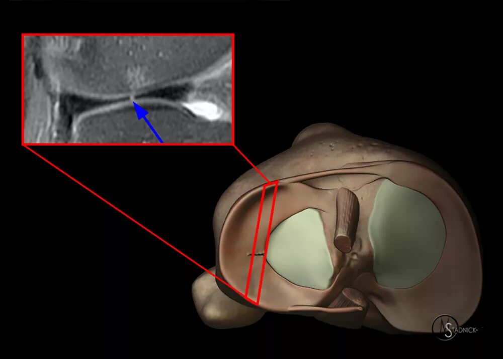 Изменение внутреннего мениска. Повреждение мениска коленного сустава мрт. Мрт коленного сустава разрыв мениска.
